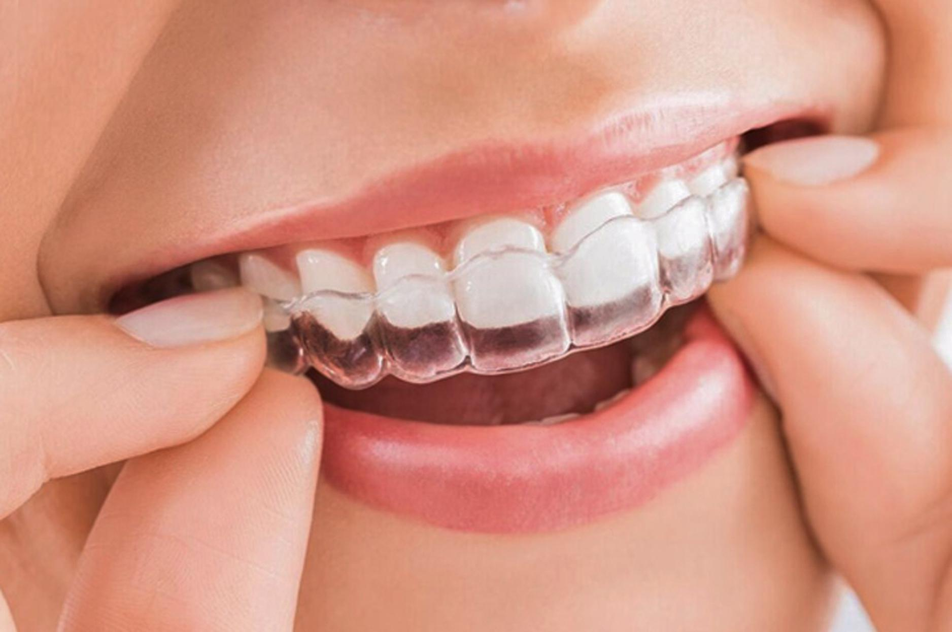 Niềng răng trong suốt Invisalign có chi phí thực hiện cao nhất trong tất cả phương pháp niềng răng