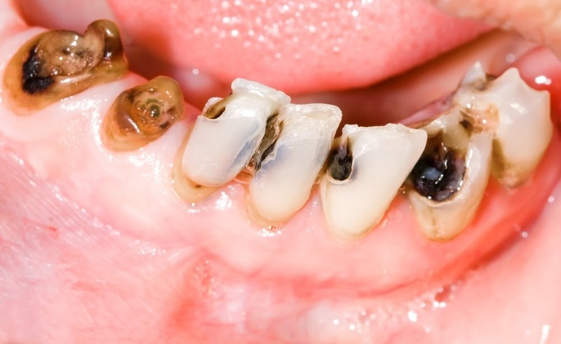 Giá niềng răng tại TPHCM sẽ tăng nhẹ khi cần phải xử lý sâu răng trước đó
